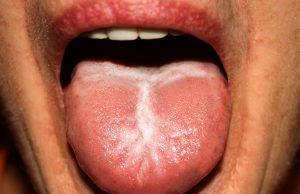 Mycose de la bouche : qu’est-ce que le muguet buccal ?