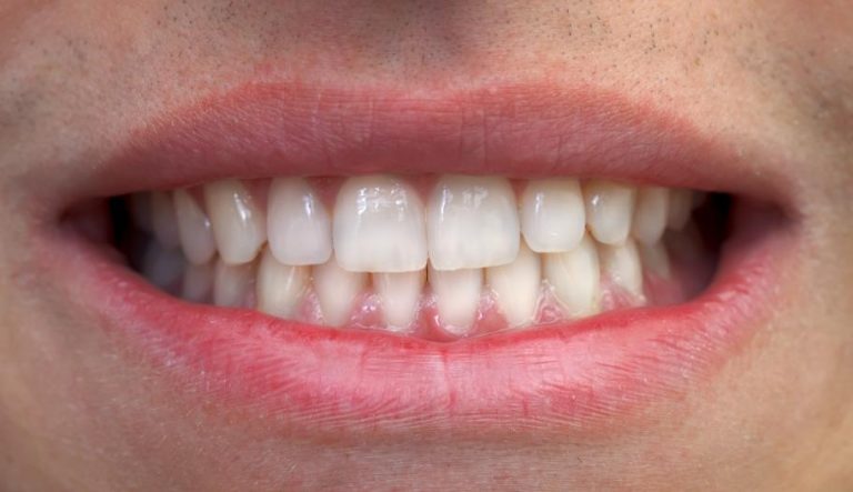 Les femmes ayant perdu des dents sont plus à risque d’hypertension artérielle