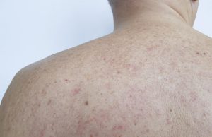 Pétéchies : est-ce un signe d’allergie au soleil ?