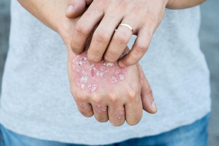 Un lien établi entre le psoriasis et les troubles mentaux