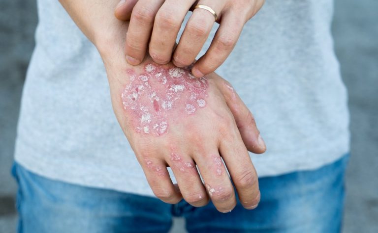 Les gens atteints de psoriasis, plus à risque de mourir d’un cancer