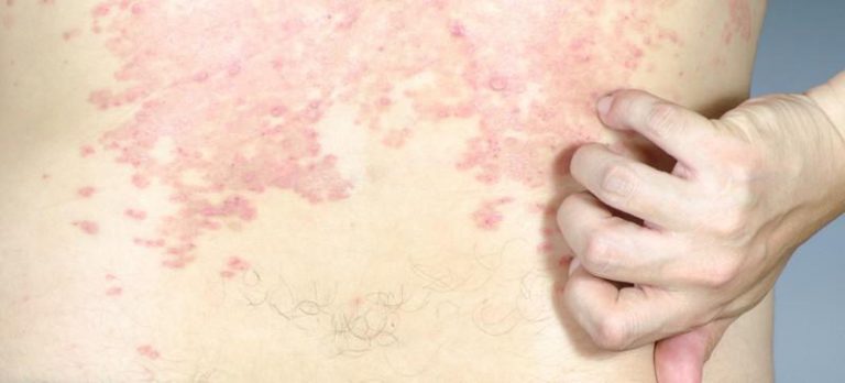 Psoriasis, eczéma, dermite séborrhéique et dermatite atopique : quelles différences ?