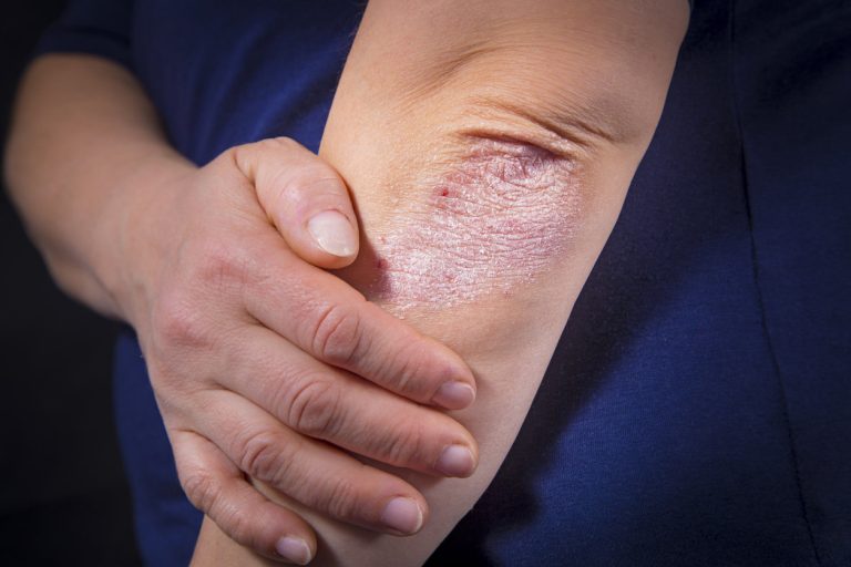 Psoriasis des coudes et genoux : quelles solutions et traitements ?