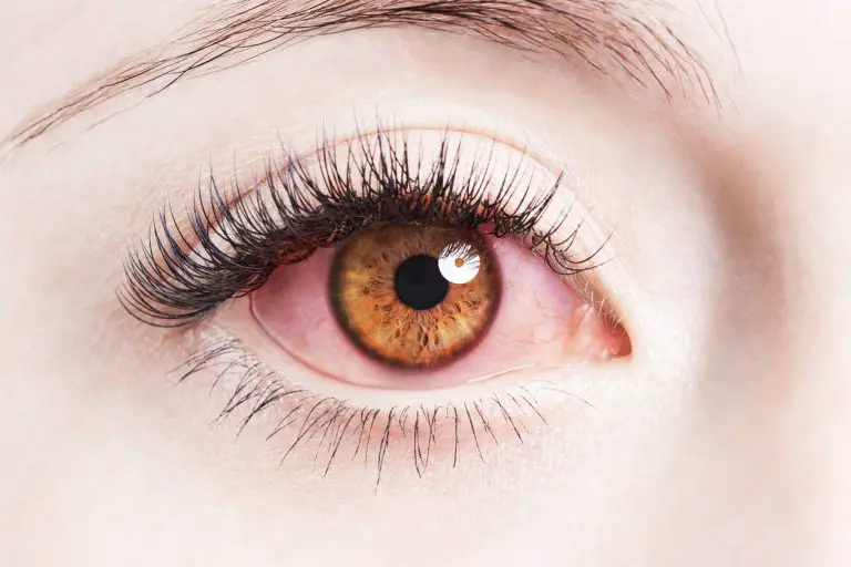 11 maladies qui donnent les yeux rouges