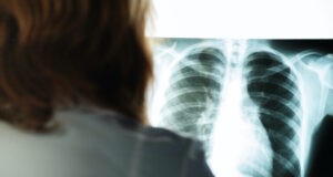 x-ray, cancer check, doctor with a picture of the lungs and chest in a medical clinic evaluates the patient's health