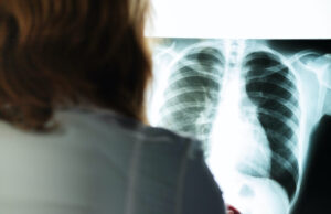 x-ray, cancer check, doctor with a picture of the lungs and chest in a medical clinic evaluates the patient's health