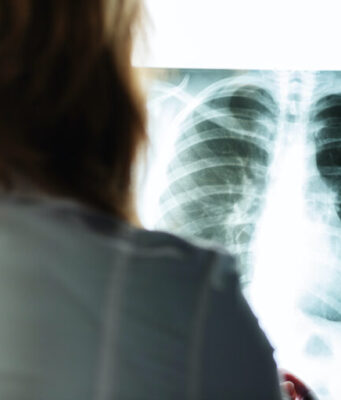 x-ray, cancer check, doctor with a picture of the lungs and chest in a medical clinic evaluates the patient's health