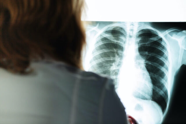 x-ray, cancer check, doctor with a picture of the lungs and chest in a medical clinic evaluates the patient's health